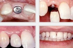 种植牙术后护理要做些什么