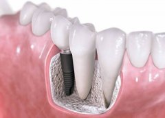 种植牙的适应症和禁忌症