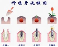 种植牙的治疗过程是哪些