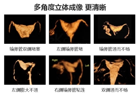 四维子宫输卵管超声造影术的优点