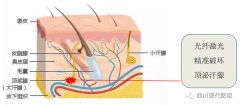 光纤激光去除腋臭