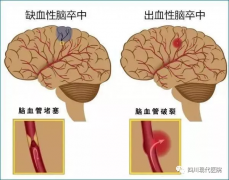 脑卒中高危人群该如何综合预防