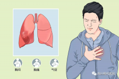 肺泡“膨胀”过度了，这是一种什么样的疾病？