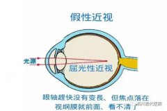 如何区分真性近视和“假性近视”呢?