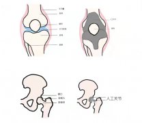 骨科带您了解膝关节置换术!