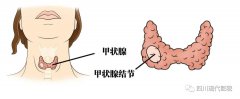 什么是甲状腺结节？