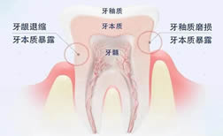 导致牙本质敏感的因素有哪些？