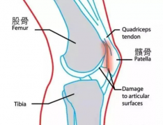 有一种膝盖疼，叫髌骨软化