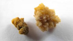 长期喝有水垢的水会长结石吗?
