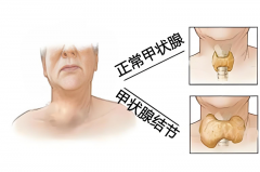 甲状腺结节何时应该就医