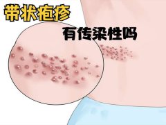 进入高发期带状疱疹有传染性吗