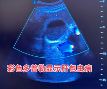 得了肝包虫病有哪些症状