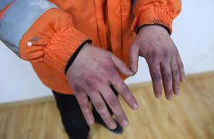 为何冻伤要去烧伤科?