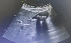 超声为什么能检查腹痛?