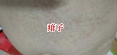 夏日认清高发皮肤病，科学应对