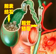 胆管结石：不是＂长在胆管里＂那么简单